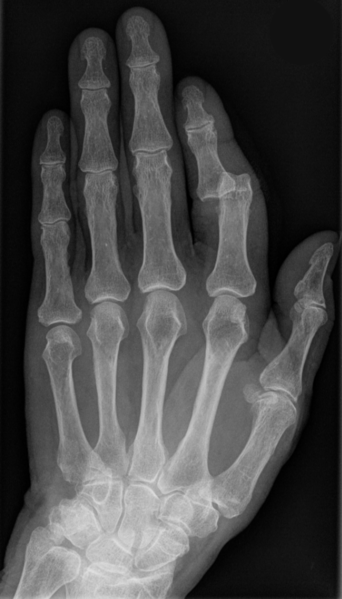 Datei:Ausgerenkter Zeigefinger.jpg