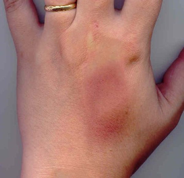 Datei:Blauer Fleck.jpg