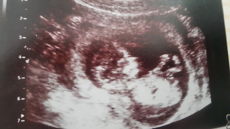 Datei:Fötus Embryo Ultraschall 2.jpg