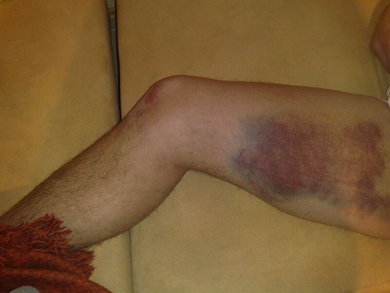 Datei:Muskelfaserriss mit Bluterguss.jpg